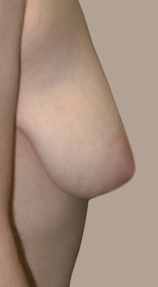 Before-Breast Augmentation