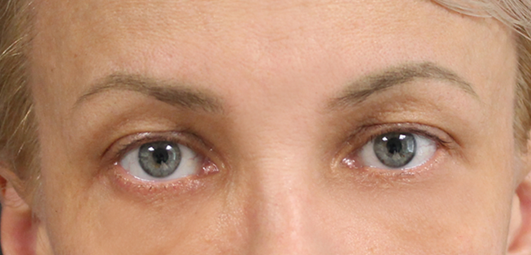 Before-Eyelid